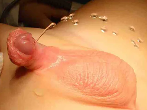 Spodziectwo, przykład 5